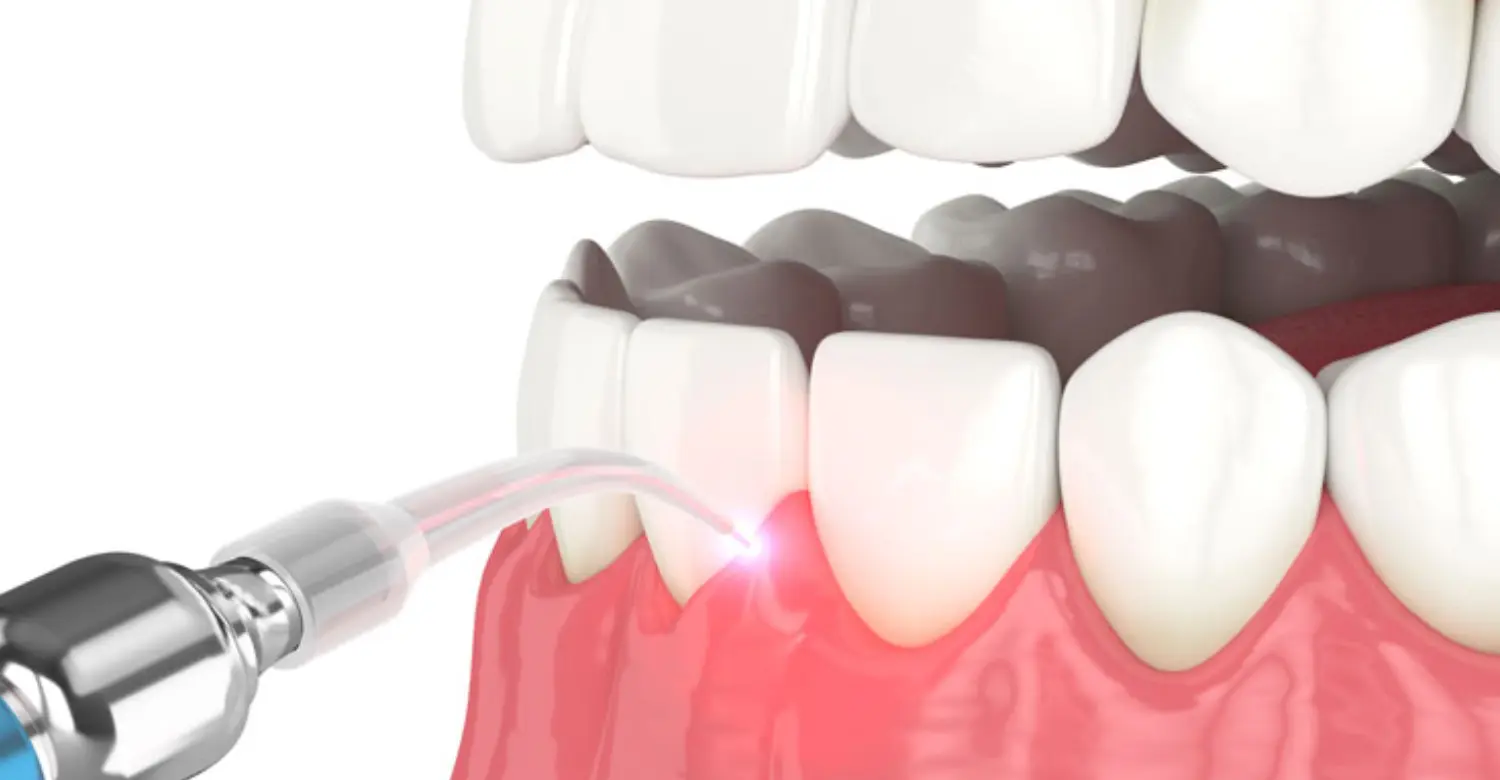 Laser Treatment for Gum Disease 2